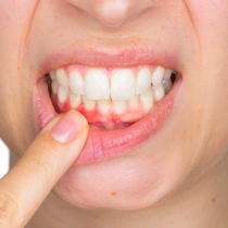 A person pointing to bleeding gums